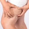 Lipedema também pode atingir homens